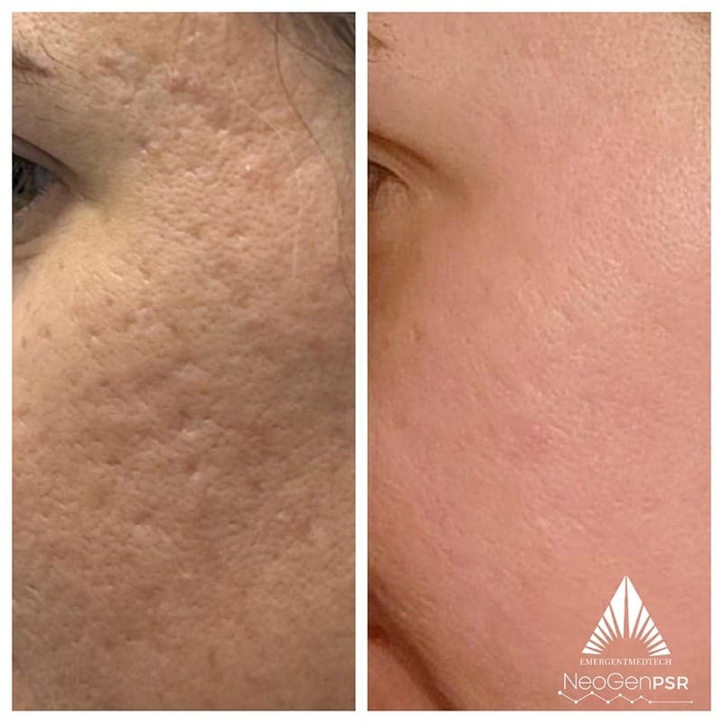 Injectables before & after photo