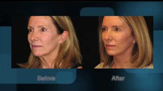Benefits to a Facelift