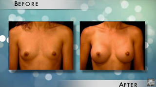 Candidates for Breast Augmentation