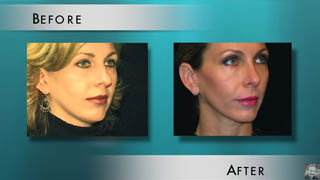 Achieving a Natural Looking Rhinoplasty