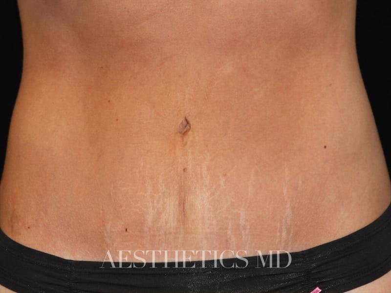 Abdominoplasty Newport Beach | Before & After Photo