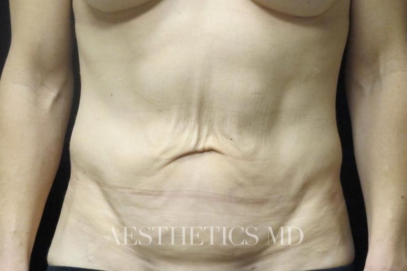 Abdominoplasty Newport Beach | Before & After Photo