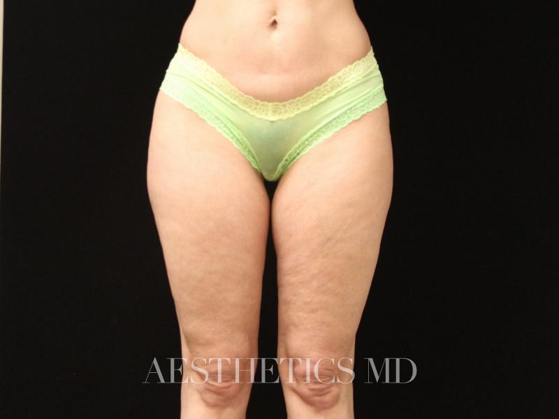 Liposuction Newport Beach | Before & After Photo