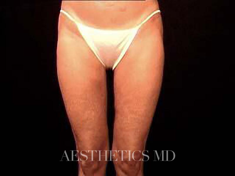 Lower body lift Newport Beach | Before & After Photo