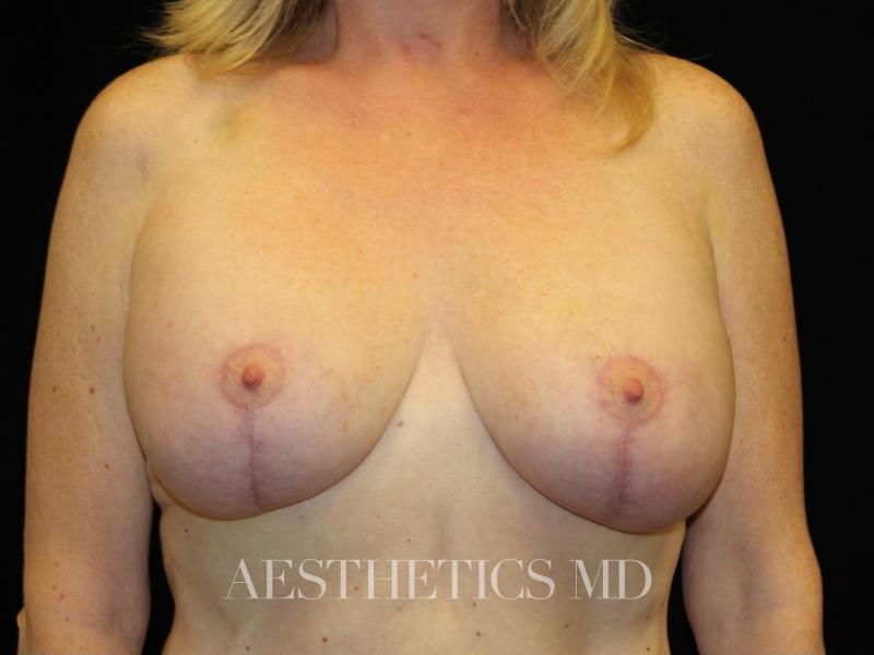 Breast augmentation with lift Newport Beach | Before & After Photo