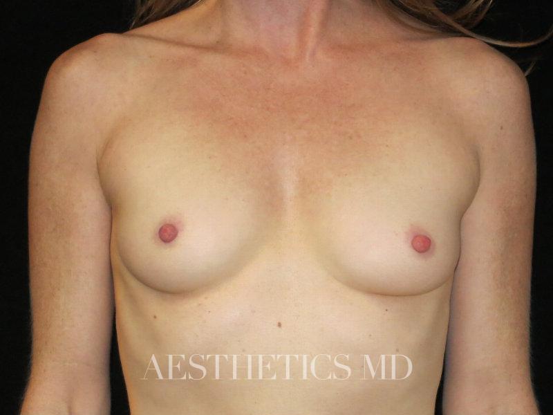 Breast augmentation Newport Beach | Before & After Photo