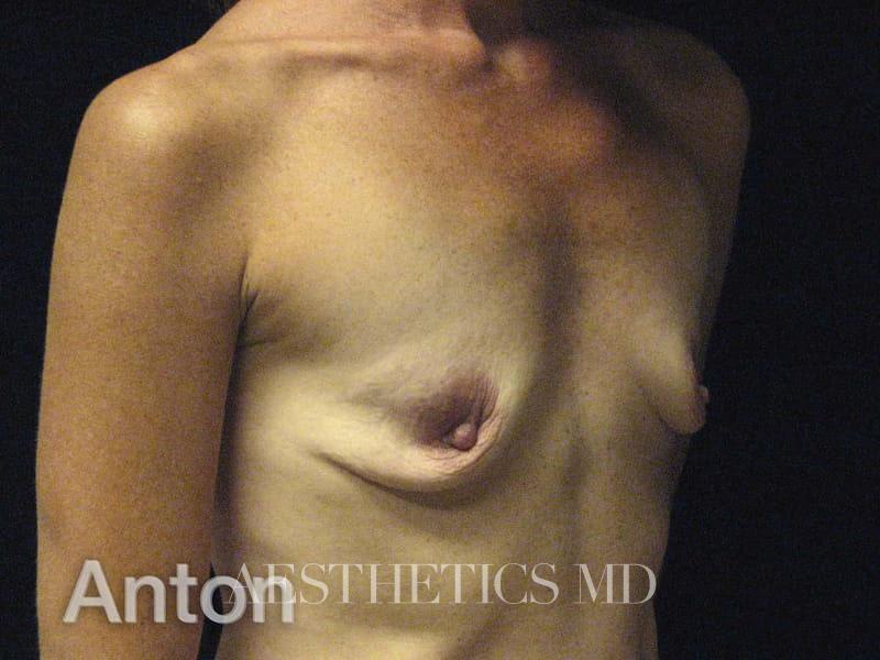 Breast augmentation Newport Beach | Before & After Photo