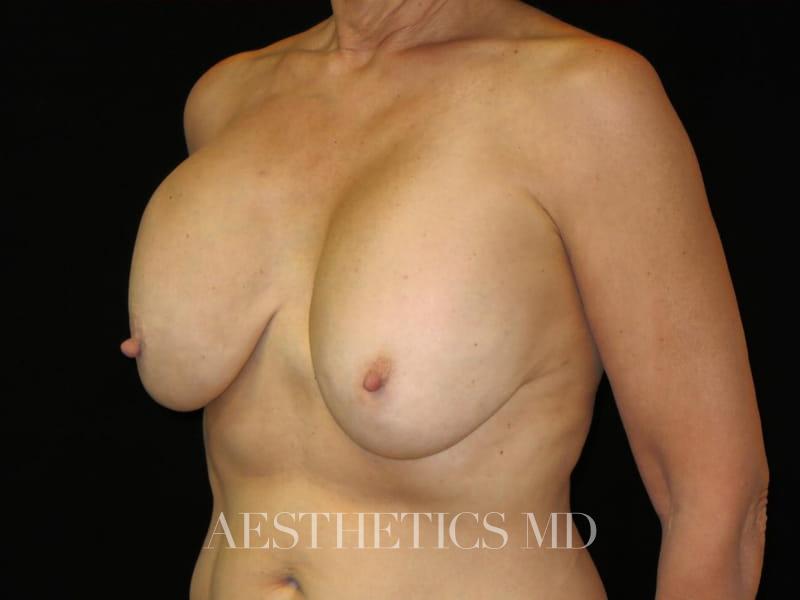 Breast implant revision with lift Newport Beach | Before & After Photo