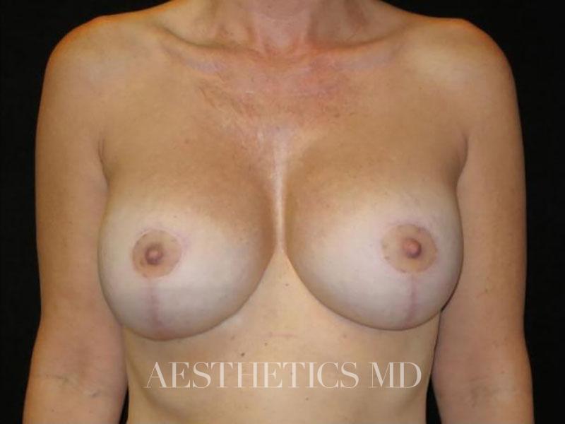 Breast implant revision with lift Newport Beach | Before & After Photo