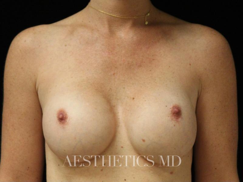 Breast implant revision Newport Beach | Before & After Photo