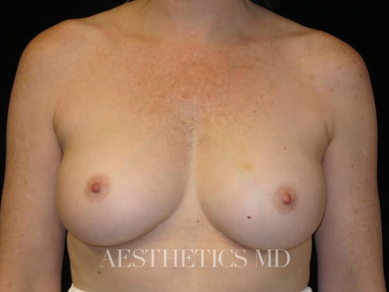 Breast implant revision Newport Beach | Before & After Photo