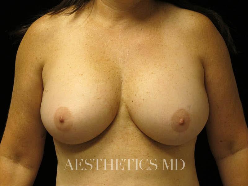 Breast lift Newport Beach | Before & After Photo