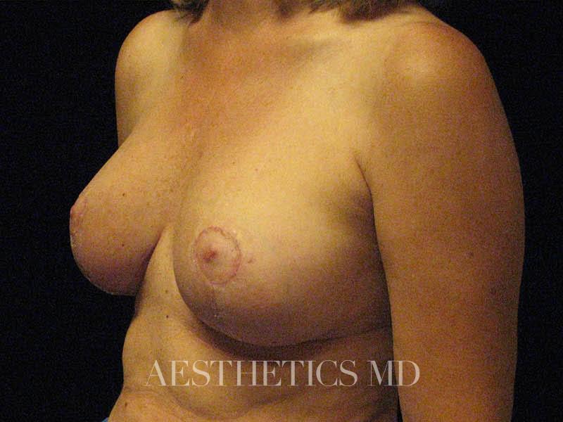 Breast lift Newport Beach | Before & After Photo
