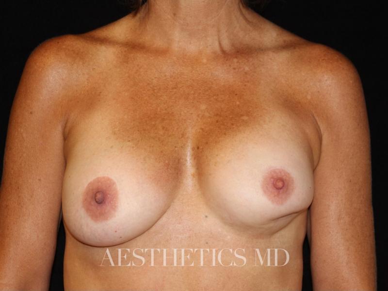 Breast reconstruction Newport Beach | Before & After Photo