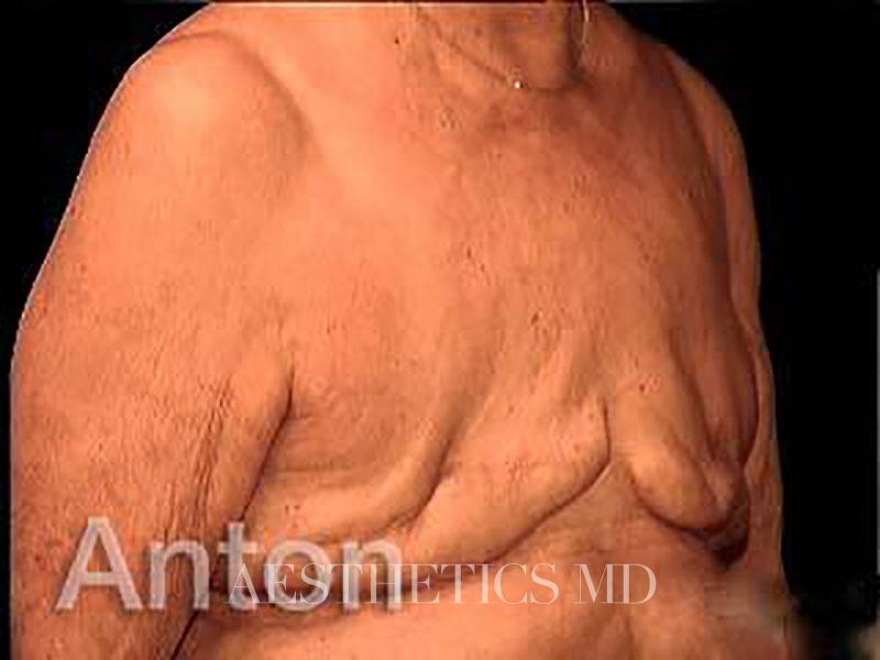Breast reconstruction Newport Beach | Before & After Photo