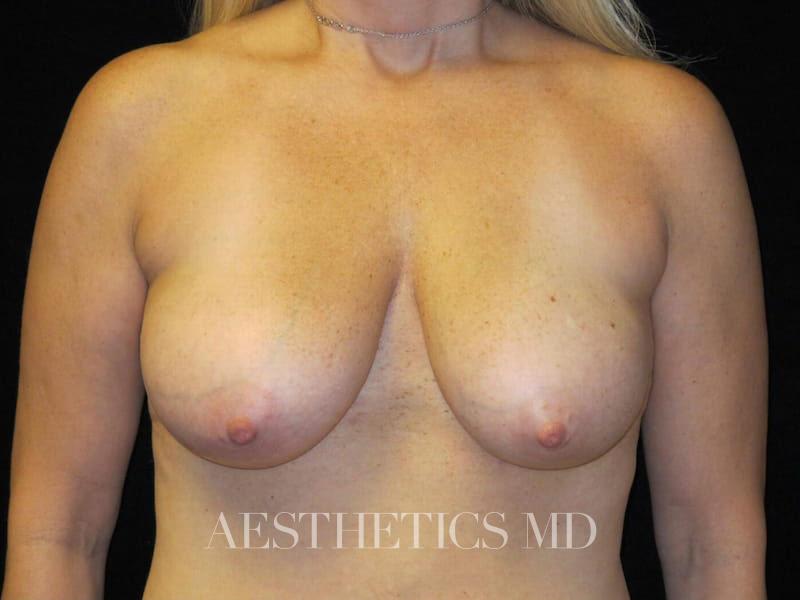 Breast reduction lift without implants Newport Beach | Before & After Photo