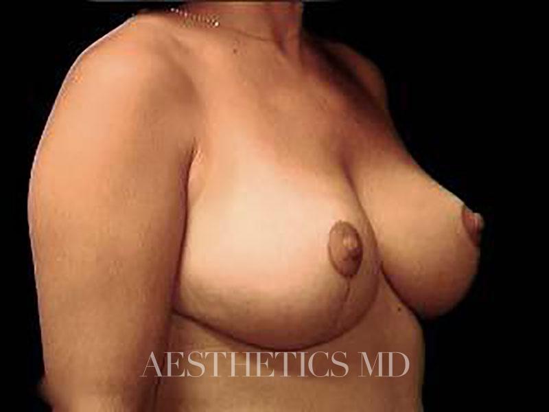Breast reduction lift without implants Newport Beach | Before & After Photo