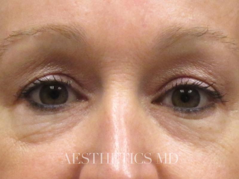 Blepharoplasty Newport Beach | Before & After Photo