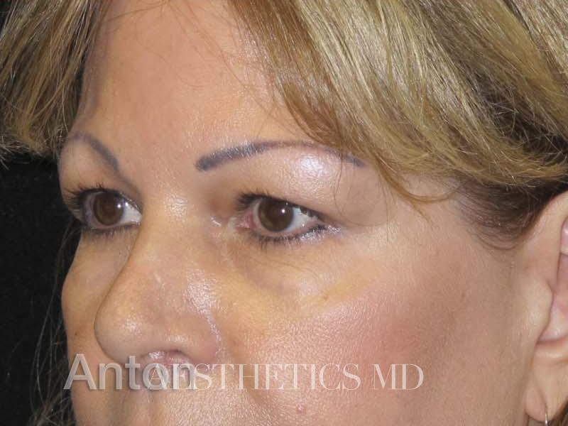 Blepharoplasty Newport Beach | Before & After Photo
