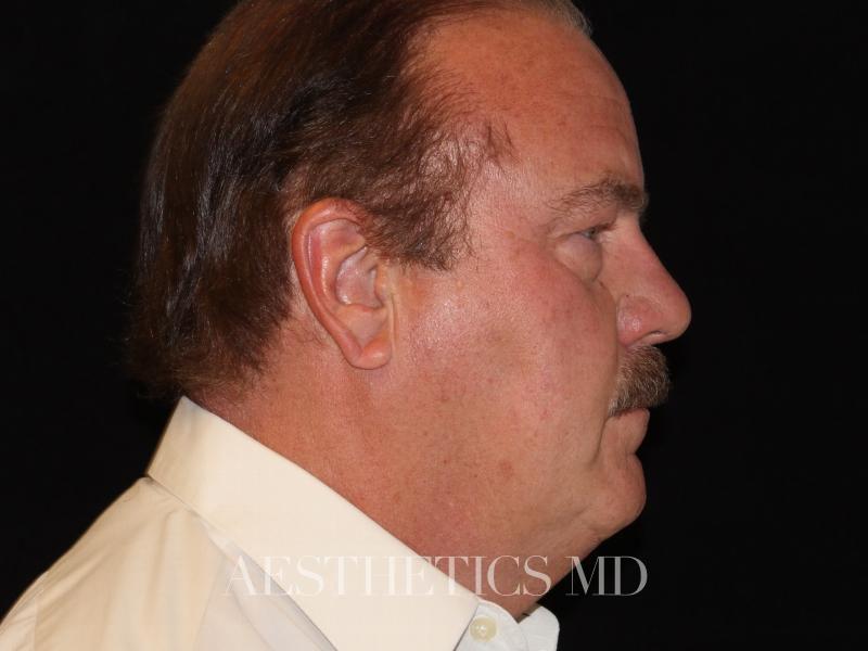 Face neck liposuction Newport Beach | Before & After Photo