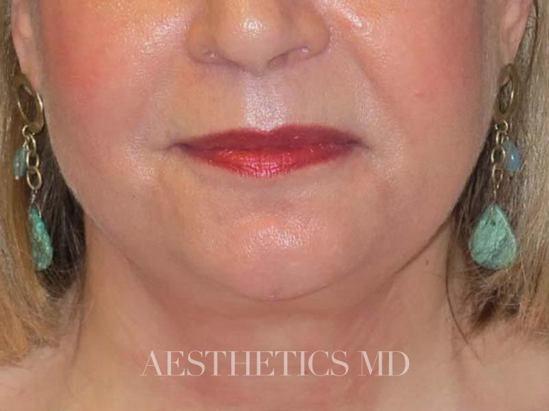 Face neck liposuction Newport Beach | Before & After Photo