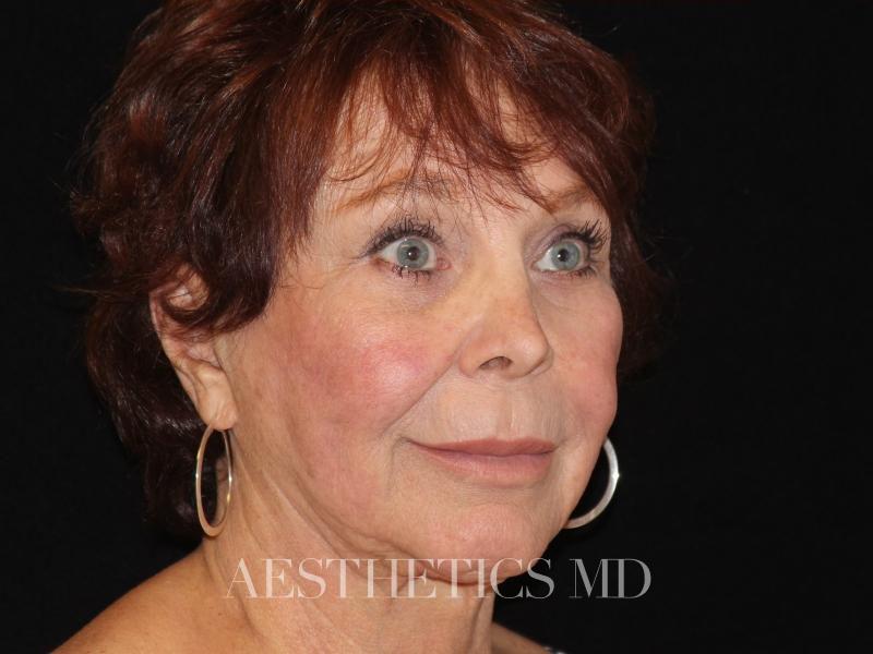 Facelift Newport Beach | Before & After Photo