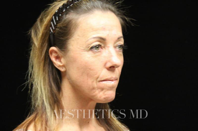 Injectables Newport Beach | Before & After Photo