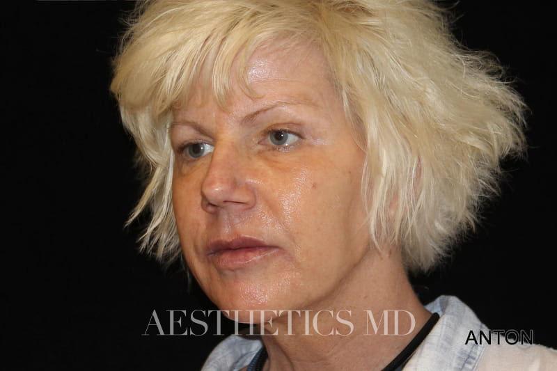Injectables Newport Beach | Before & After Photo