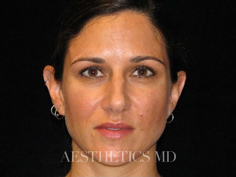 Otoplasty Newport Beach | Before & After Photo