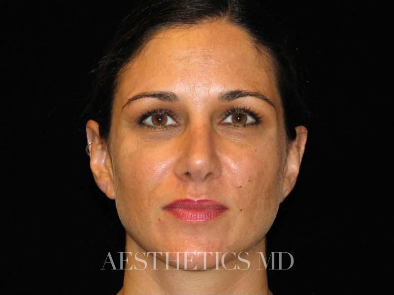 Otoplasty Newport Beach | Before & After Photo