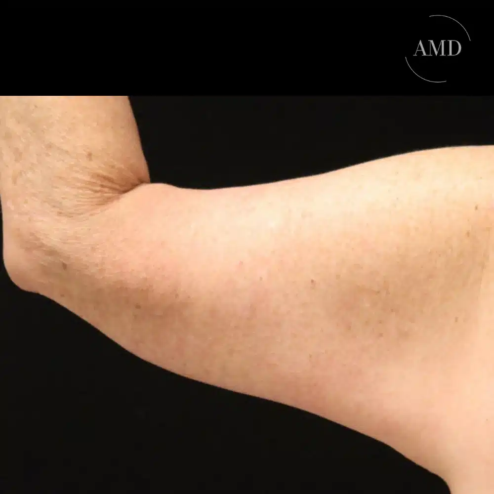 Brachioplasty patient at Aesthetics MD in Newport Beach, CA.