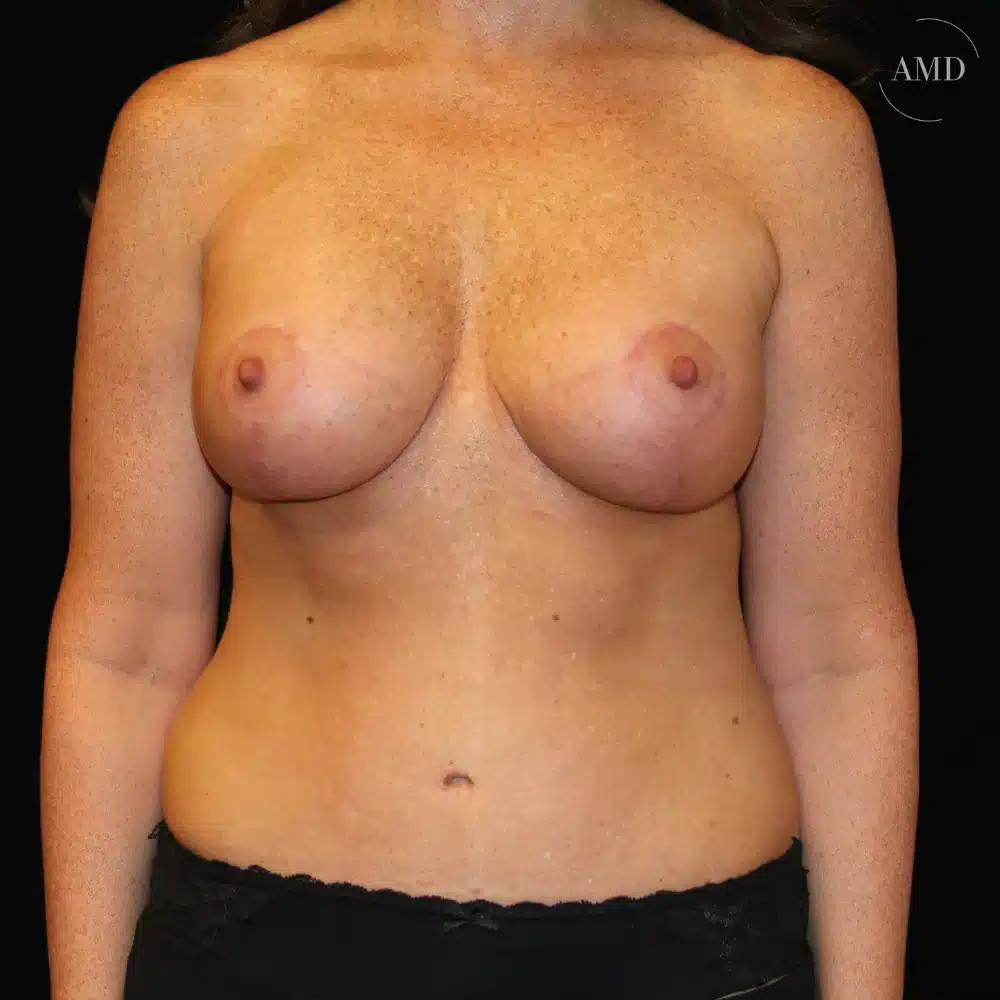 Lower body lift before and after patient at Aesthetics MD in Newport Beach, CA.