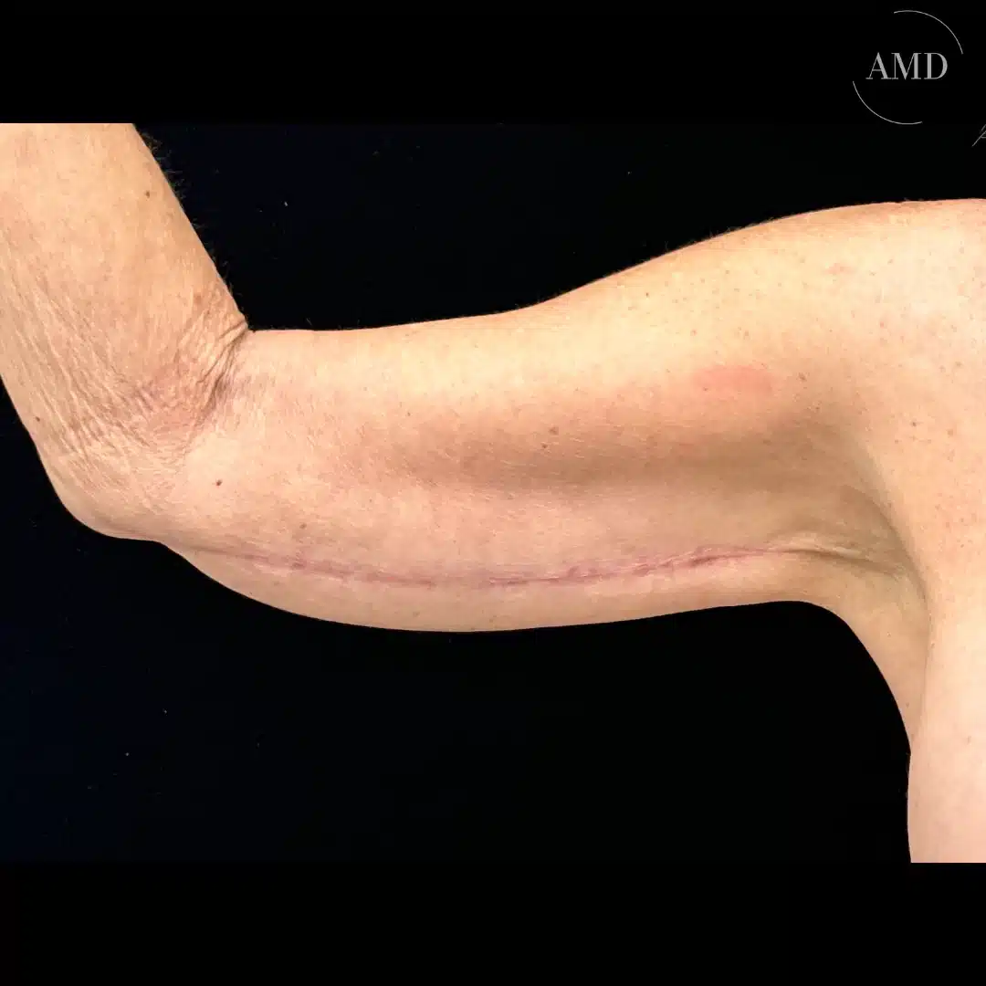 Lower body lift before and after patient at Aesthetics MD in Newport Beach, CA.