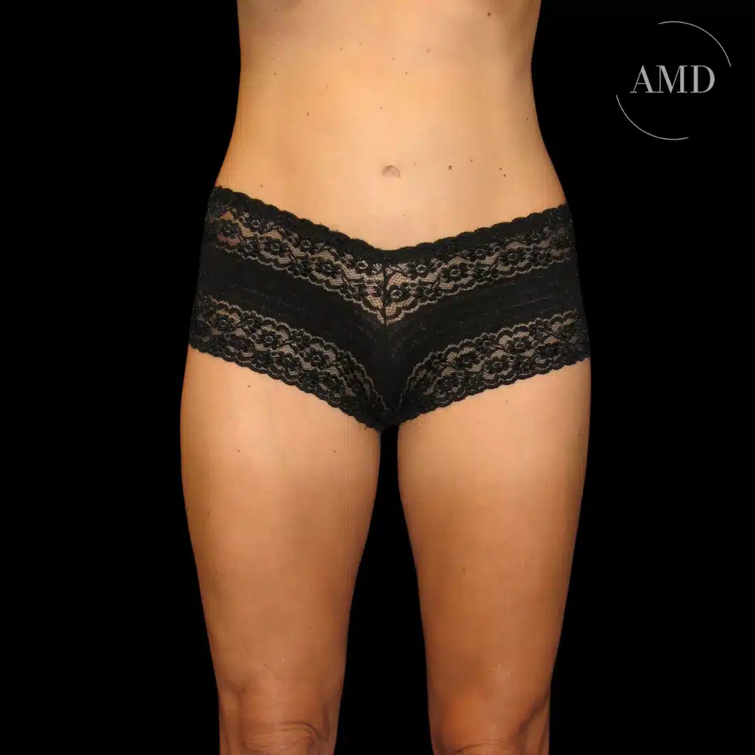 Lower body lift before and after patient at Aesthetics MD in Newport Beach, CA.