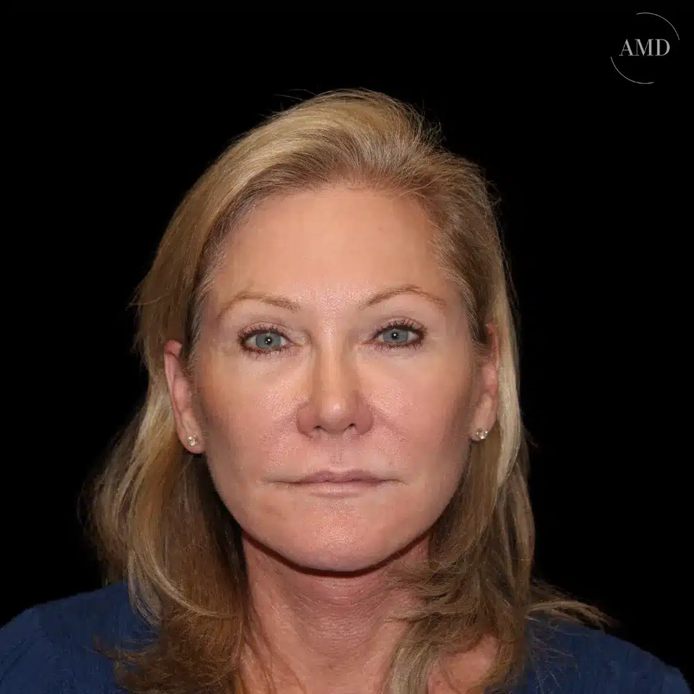 Lower body lift before and after patient at Aesthetics MD in Newport Beach, CA.
