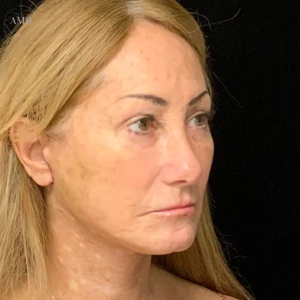 Lower body lift before and after patient at Aesthetics MD in Newport Beach, CA.