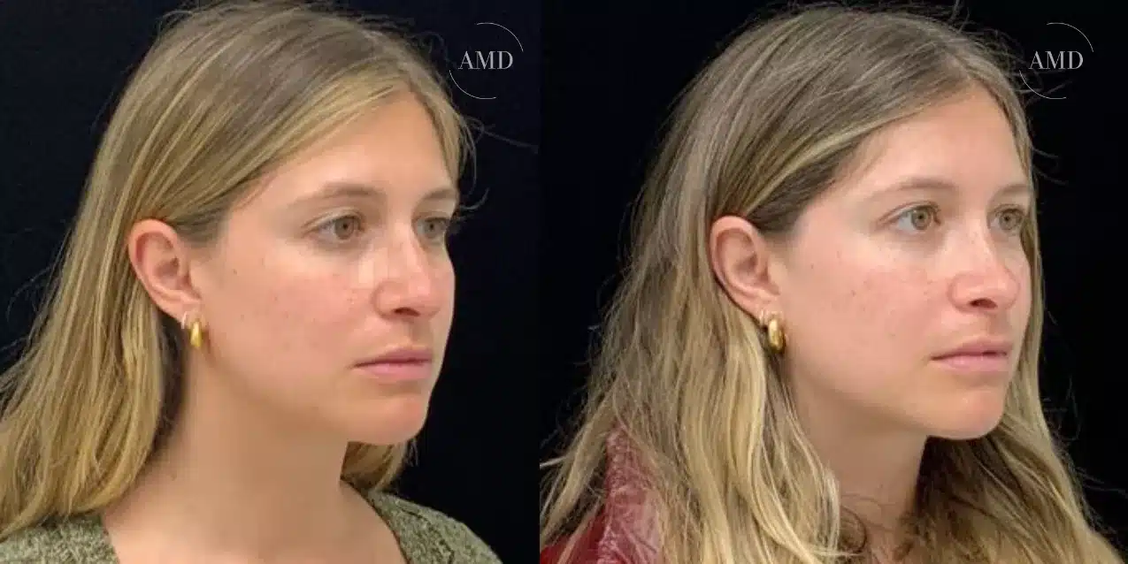 casenose1-691098b89ce58 casenose1 691098b89ce58