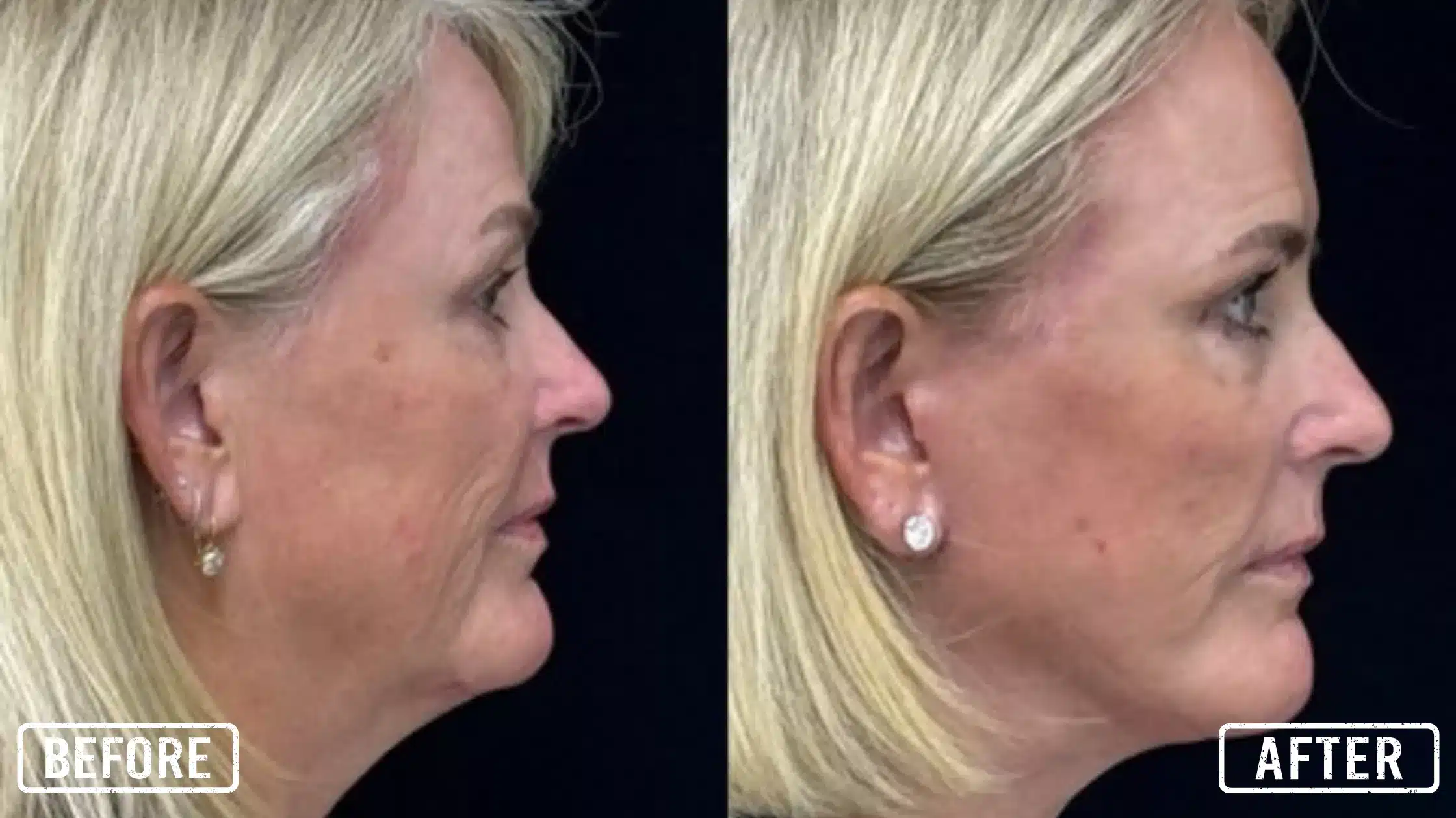 Facelift results Aesthetics Md